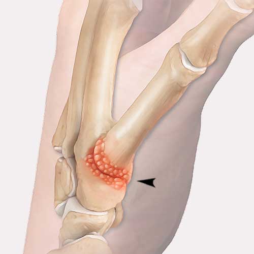 base thumb arthritis