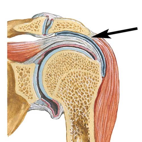 shoulder bursitis